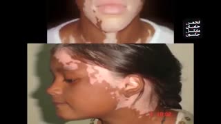 مستندی کامل در مورد چگونگی سفید شدن پوست مایکل جکسون