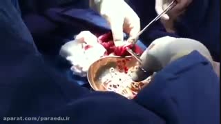 روده‌ای پر از کرمهای انگل