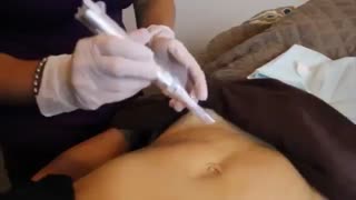 microneedling