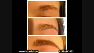 کاشت ابرو - مرکز تخصصی موی رنسانس