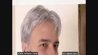 ترمیم مو به روش انحصاری HRT مرکز تخصصی موی رنسانس