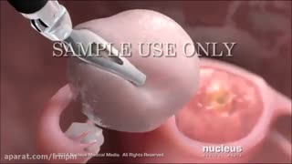 جراحی لاپاراسکوپی رحم به کمک ربات