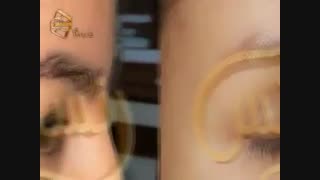 کاشت ابرو طبیعی با روش SUT مرکز کاشت مو رنسانس جوانسازی پوست