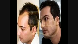 کاشت مو به روشSUT مرکز مو رنسانس