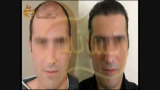 کاشت مو به روشSUT مرکز مو رنسانس