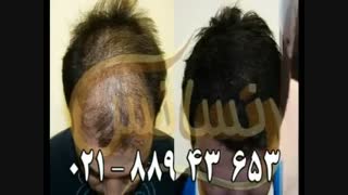 کاشت مو به روش SUT مرکز تخصصی مو رنسانس