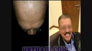 کاشت مو به روش SUT مرکز تخصصی مو رنسانس