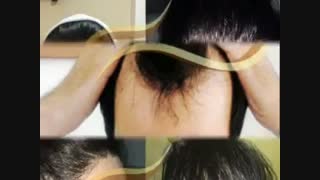کاشت مو به روش SUT مرکز تخصصی مو رنسانس