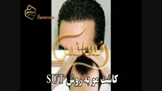 کاشت مو به روش SUT مرکز تخصصی مو رنسانس