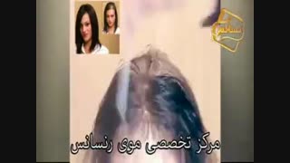 کاشت مو به روش HRT مرکز تخصصی مو رنسانس