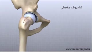 آناتومی مفصل ران در ناحیه لگن