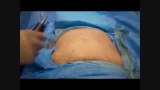 جراحی لیپوماتیک یا پیکر تراشی - تخلیه چربی شکم - زیبایی سنتر