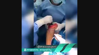 گذاشتن پروتز زانو | دکتر مسعود صابری متخصص ارتوپد عمل زیبایی