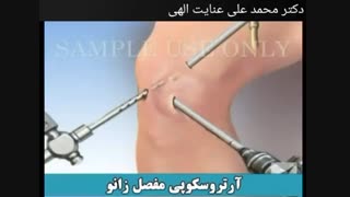 آرتروسکوپی زانو