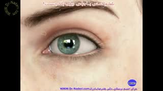 بلفاروپلاستی چیست؟مرکز چشم پزشکی دکتر علیرضا نادری