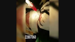 کاشت مو - دکتر ابدالی - 26151517