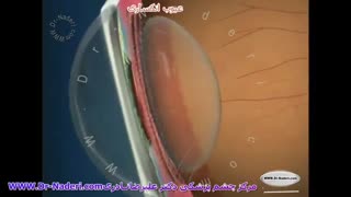 منظور از عیوب انکساری چیست؟- مرکز چشم پزشکی دکتر نادری