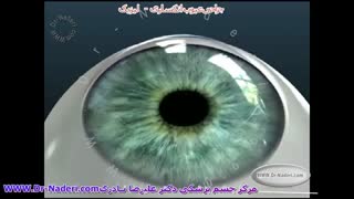 جراحی لیزیک-مرکز چشم پزشکی دکتر علیرضا نادری