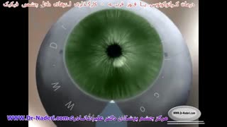 کارگذاری لنز آرتیزان و آرتیفلکس در قوز قرنیه -مرکز چشم پزشکی دکتر علیرضا نادری