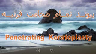 پیوند تمام ضخامت قرنیه در قوز قرنیه - قرنیه مرکز چشم پزشکی دکتر علیرضا نادری