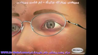 لنزهای تماسی پیرچشمی - مرکز چشم پزشکی دکتر علیرضا نادری