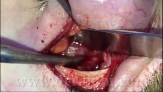 جراحی تومور سقف کاسه چشم