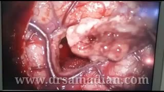 رفع تشنج مقاوم به درمان در جوان 18 ساله