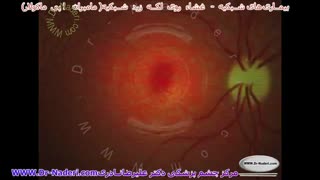 ایجاد غشاء روی لکه زرد شبکیه-مرکزچشم پزشکی دکترعلیرضا نادری
