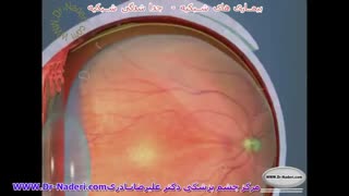 جداشدگی شبکیه Detachment-مرکزچشم پزشکی دکترعلیرضا نادری