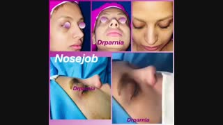 نمونه های عمل بینی دکتر رفیع پرنیا فوق تخصص جراحی پلاستیک
