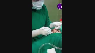 تصاویری از جراحی بینی در حین عمل