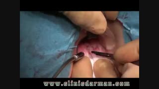 جراحی فیستول از روشهای درمان تهاجمی - کلینیک پایتخت