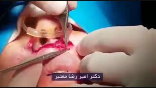 فیلم جراحی لیفت سانترال لب