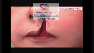 بررسی میزان شیوع شکاف کام و لب و عوامل خطرساز مرتبط با آن |گفتار توان گستر البرز 09121623463