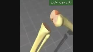 آرتروز زانو و ساییدگی مفصل زانو