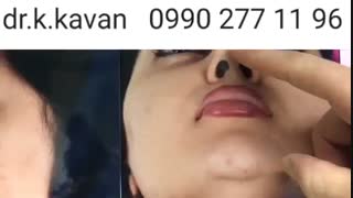 عمل زیبایی بینی توسط دکتر کاوان