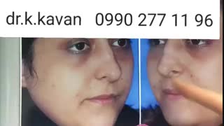 عمل زیبای بینی توسط دکتر کیوان کاوان جرمگیری