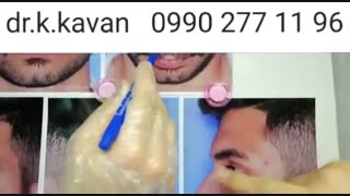 عمل بینی استخوانی و گوشتی توسط دکتر کاوان
