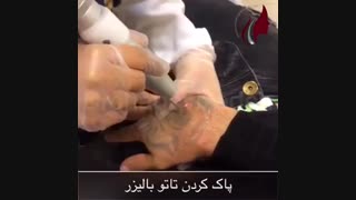 فیلم پاک کردن تتو با لیزر