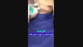 فیلم رفع غبغب و زاویه سازی فک
