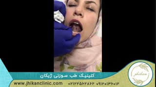 خونگیری زیر زبان برای درمان سودای مغز و لکنت زبان