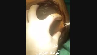 درآوردن توده چربی - دکتر ابدالی - 22807060