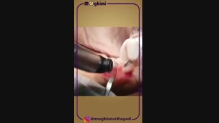 فیلم جراحی هالوکس والگوس شدید